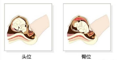 胎儿臀位和性别真没关系，小心胎位不当影响分娩